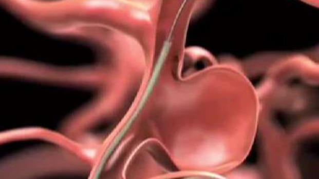 [TLMD - PR] Pudiera tener una aneurisma cerebral y no saberlo