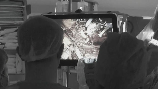 Realizan exitoso trasplante robótico de riñón