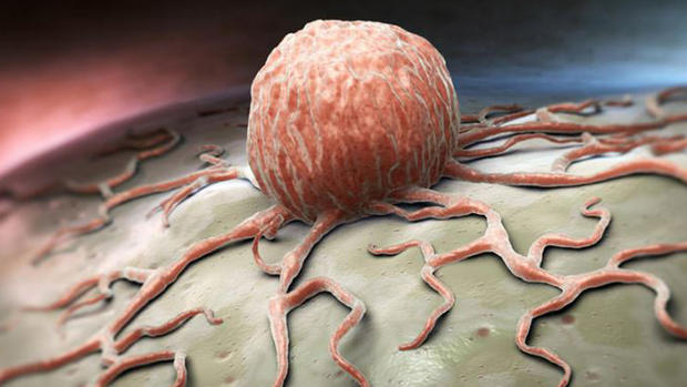 Qué es el temible cáncer y cómo prevenirlo