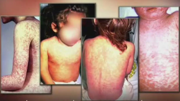 Preocupación por aumento de casos de sarampión en EEUU