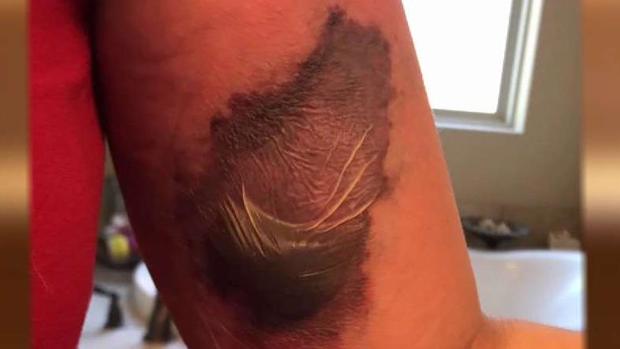 [TLMD - Dallas] Mujer sobrevive a la bacteria come carne