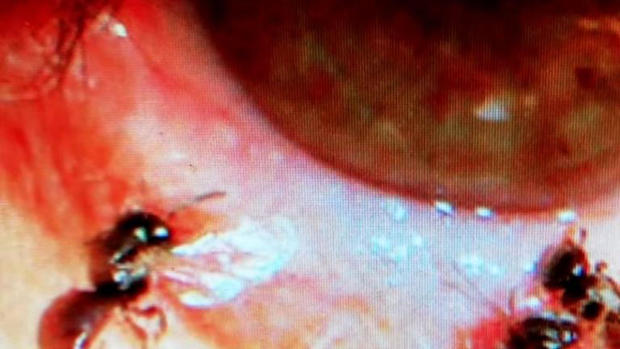 [TLMD - LV] Le sacan cuatro abejas vivas del ojo