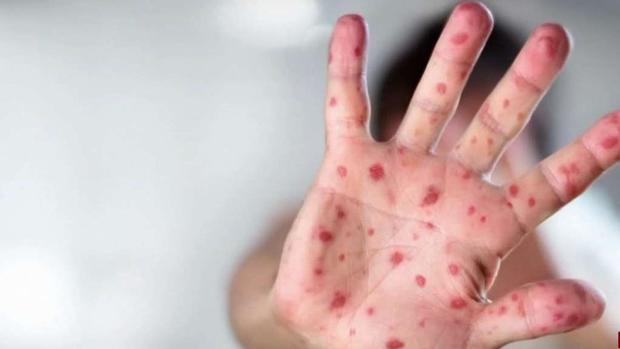 Se confirman cinco casos de sarampión en Los Ángeles