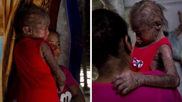 “Niña de piel de pescado” en Nicaragua recibe un “milagro”