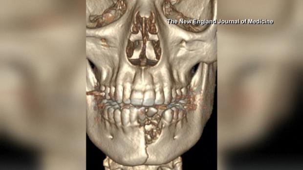 [TLMD - LV] Cigarrillo eléctrico le explota dentro de la boca a menor