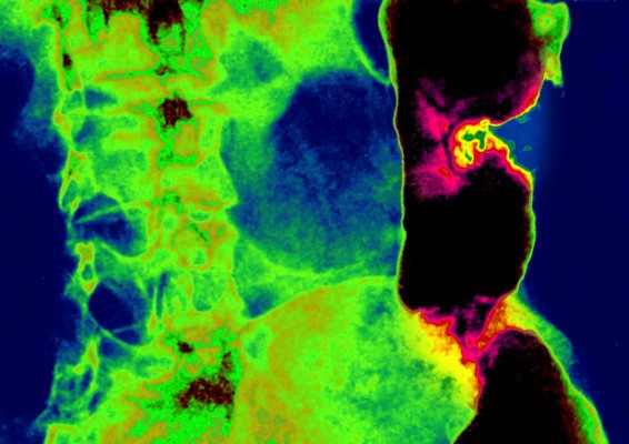 Con $ 160 millones en nuevos fondos, Freenome busca comercializar su análisis de sangre para detectar el cáncer colorrectal