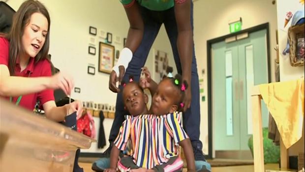 [TLMD - NATL] Increíble historia de siamesas que no pueden ser separadas