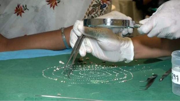 [TLMD - NATL] ¿526 dientes? Insólito hallazgo en niño con dolor en su boca por años