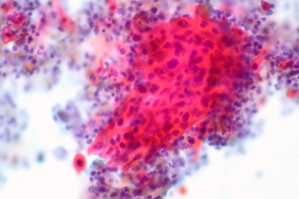 Trialjectory utiliza datos clínicos autoinformados para unir pacientes con cáncer con ensayos clínicos