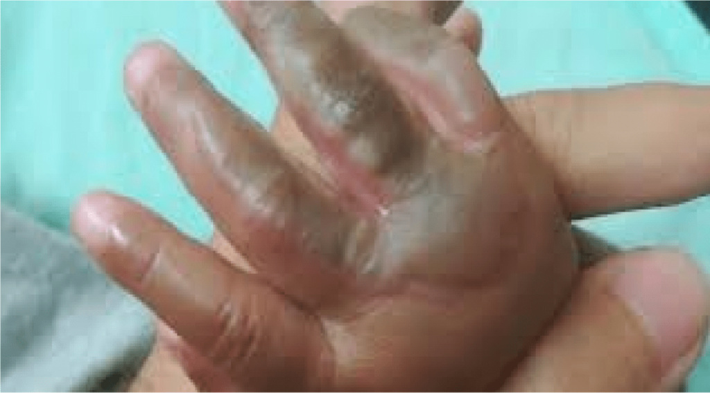 Niño de 8 años le rocía gasolina y prende fuego a otro niño de 4 años, “cerré mis ojitos muy fuerte”