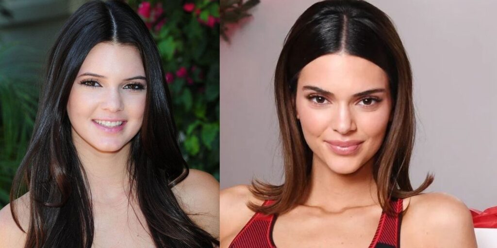 Mantenerse al día con las Kardashian: datos de la cirugía plástica de Kendall Jenner