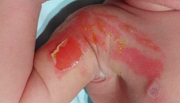 Queman a bebé en Clínica del IMSS, se investiga a personal por negligencia médica