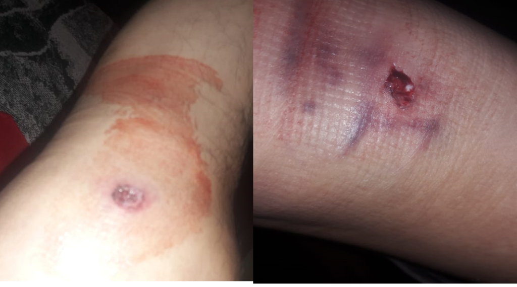 Buscan proteger en Fiscalía a sujetos que balearon a joven en La Palma, su utilizó arma de grueso calibre