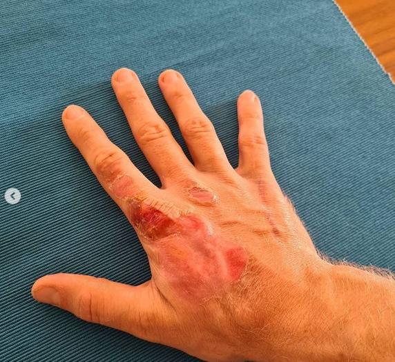 Grosjean muestra su mano tras quitarse el bendaje