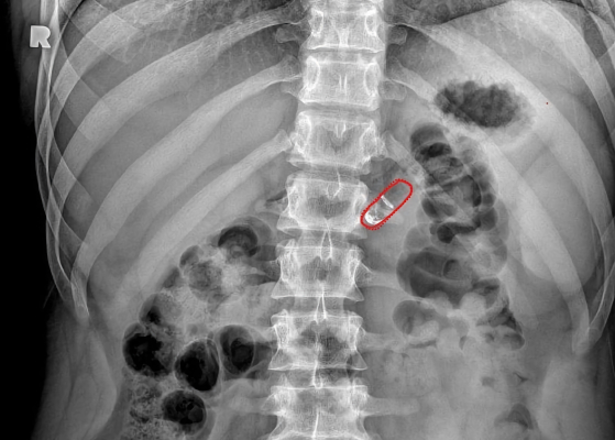 Cómo la píldora robótica de Rani Therapeutics podría cambiar el tratamiento de inyección subcutánea