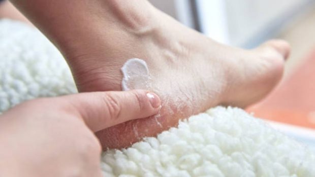 talones secos y agrietados