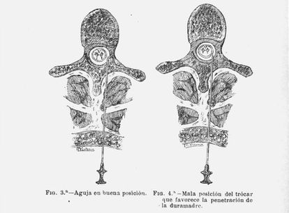 Imagen del dibujo del artículo 'Anestesia metamérica' donde Fidel Pagés describe cómo poner la aguja.