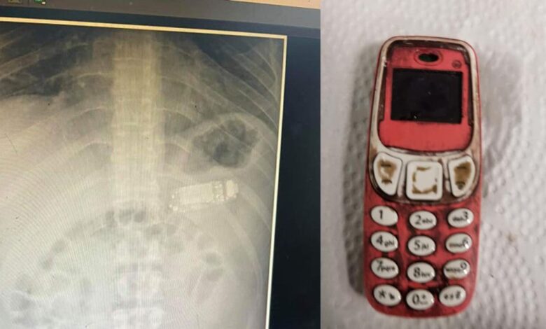 Este hombre se tragó un teléfono completo y los médicos de alguna manera lo salvaron