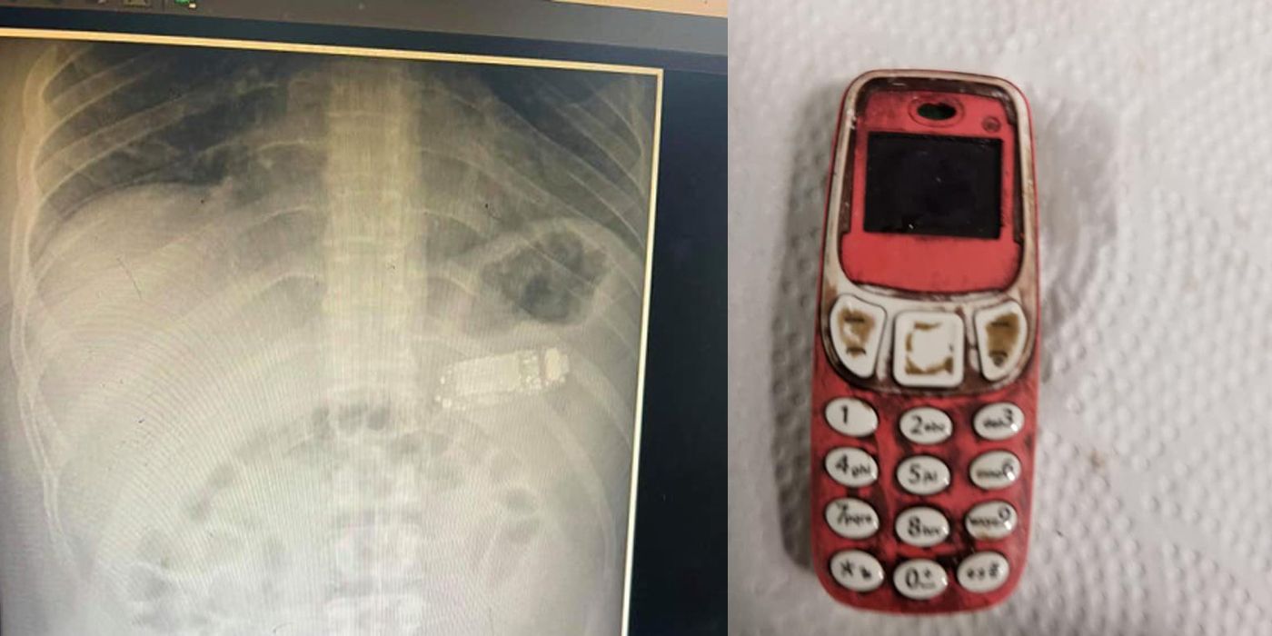 Este hombre se tragó un teléfono completo y los médicos de alguna manera lo salvaron
