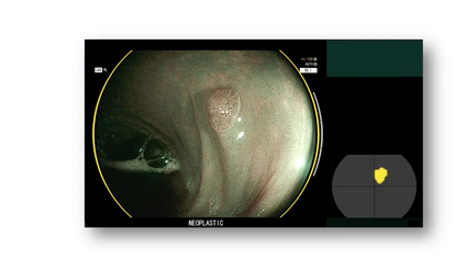 Detección de pólipos mediante la herramienta CAD-EYE, que utiliza soluciones de inteligencia artificial.