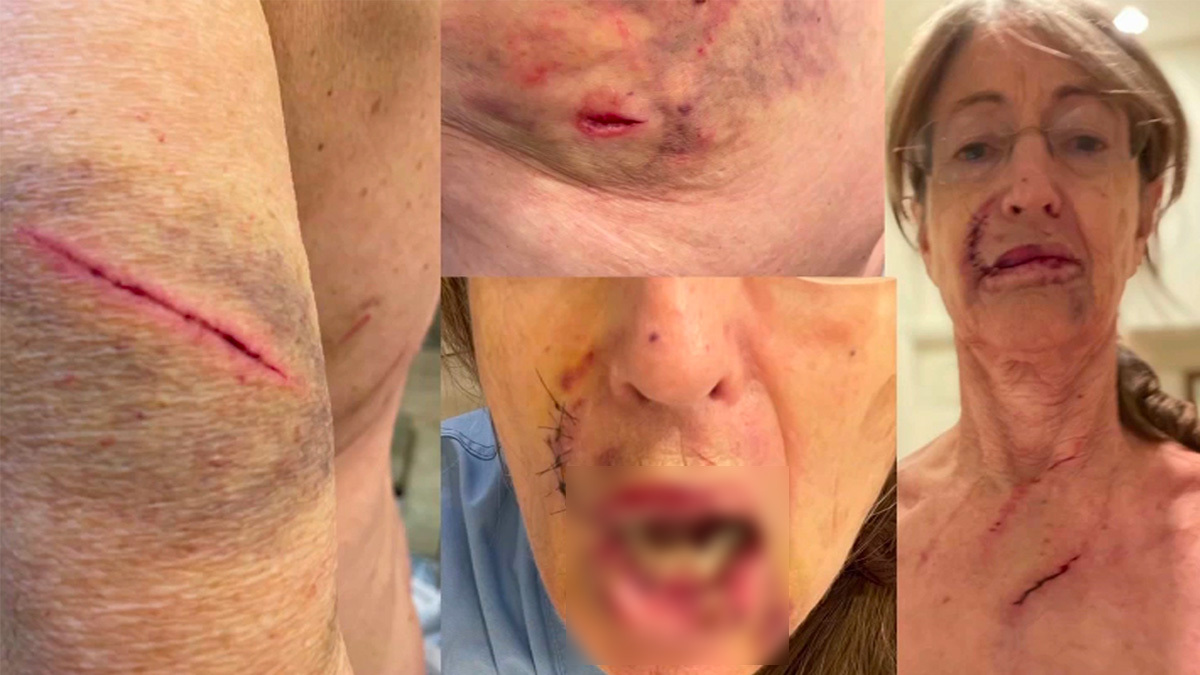 “Fue aterrador”: se encontró con un oso escarbando en la nevera y sobrevivió al feroz ataque