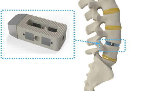 Intelligent Implants recauda $ 8.7 millones para ayudarlo a hacer crecer la columna