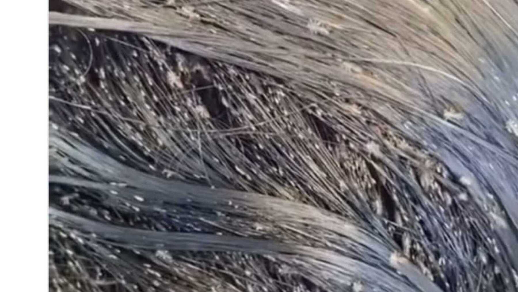 una niña con más de 15.000 piojos en el pelo