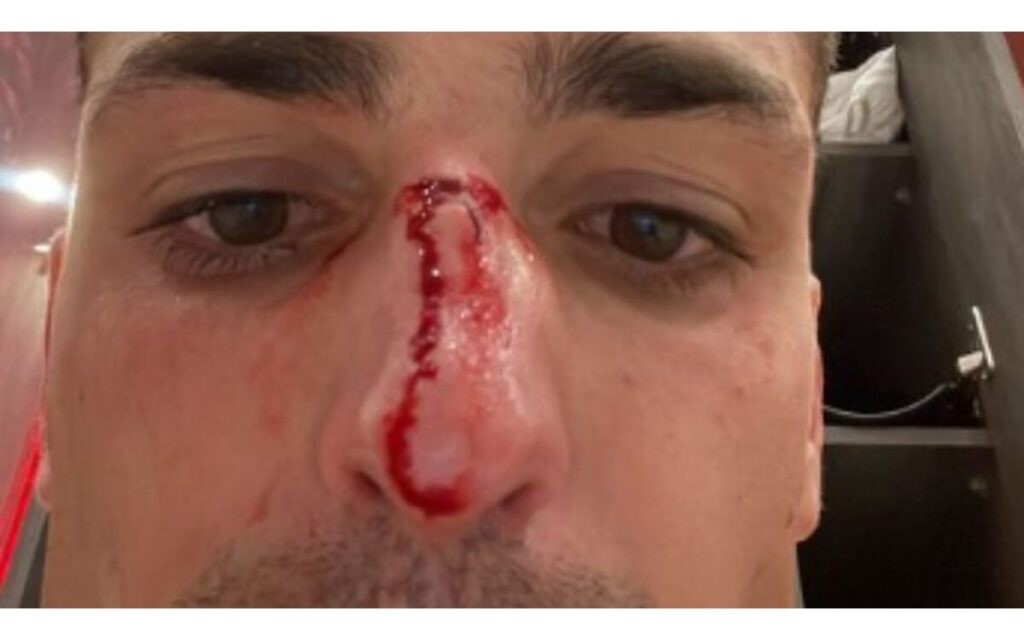 Fractura de nariz y siete puntadas, pero no hubo penal | Video