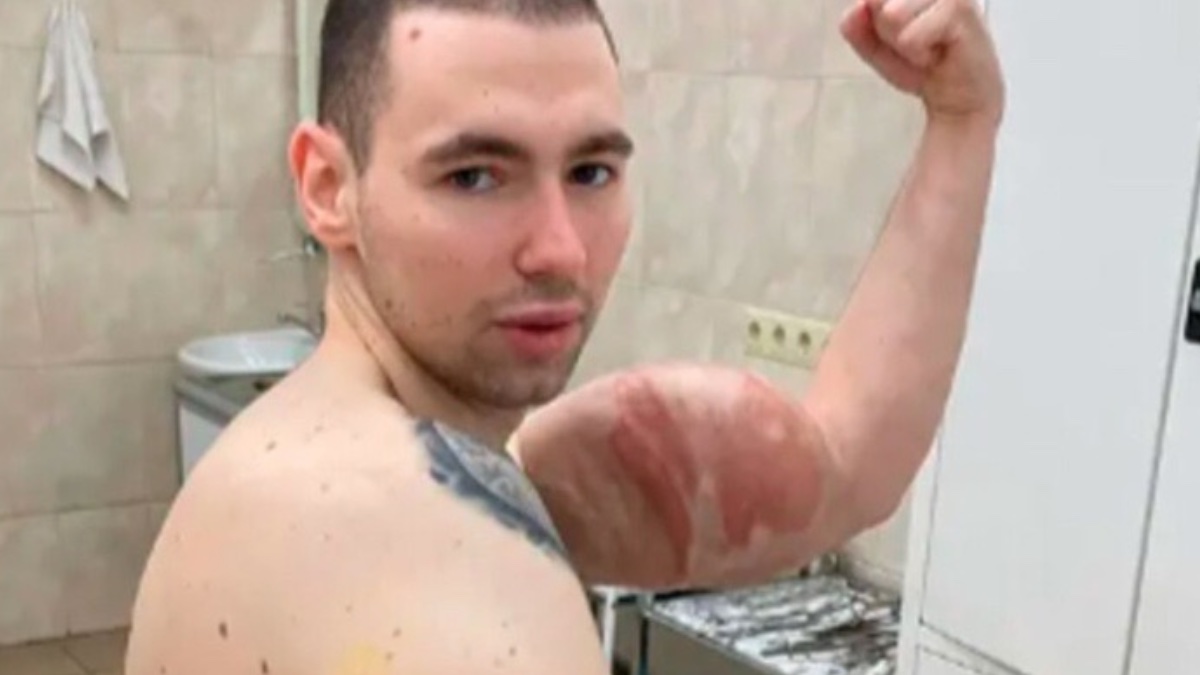 El ‘Popeye humano’, Kirill Tereshin, tendrá que operarse para eliminar sus horribles músculos