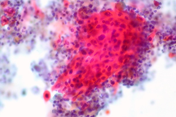 Paige, la startup de patología computacional que se enfoca en el cáncer, cierra una Serie B en $ 70M