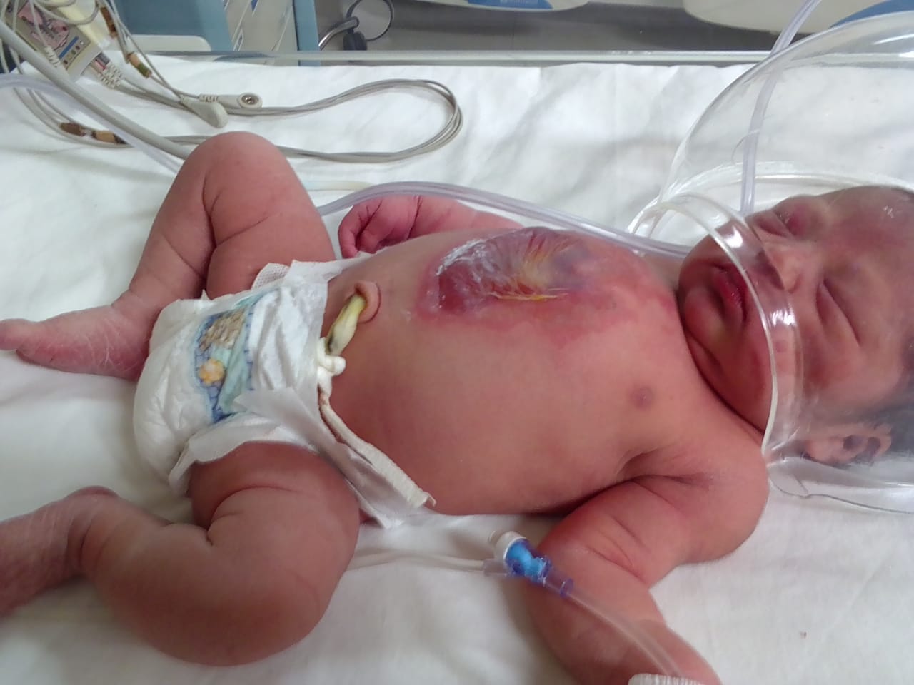 Queman a bebé en Centro de Salud de Tolimán, acusan a personal médico por negligencia