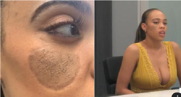 A mujer le crece vello púbico en la cara, tras injerto de piel cuando era niña