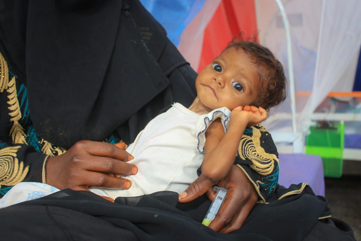 El círculo vicioso de la desnutrición infantil en Yemen