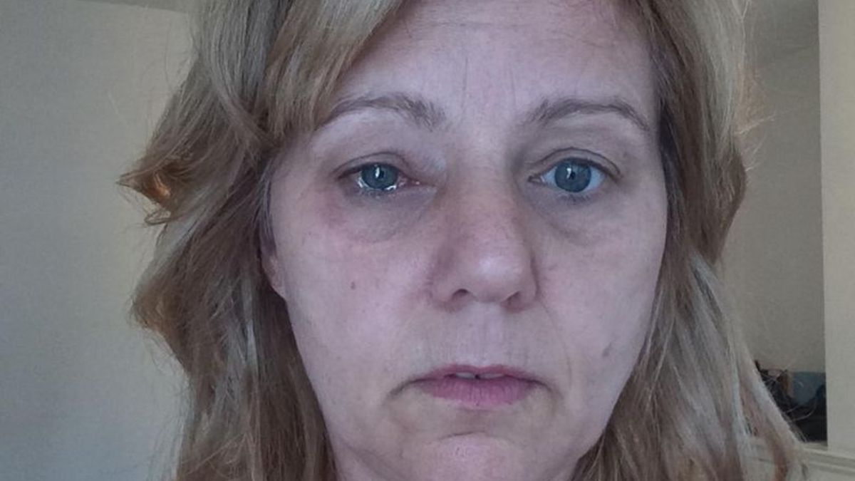 Descubre que tiene cáncer después de rociarse perfume en su ojo