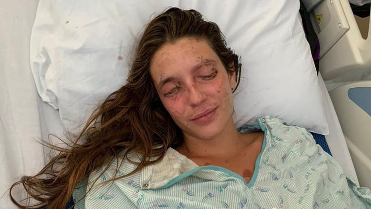 Marta, la joven española que se quemó con sosa cáustica en Estados Unidos, recuperará la vista