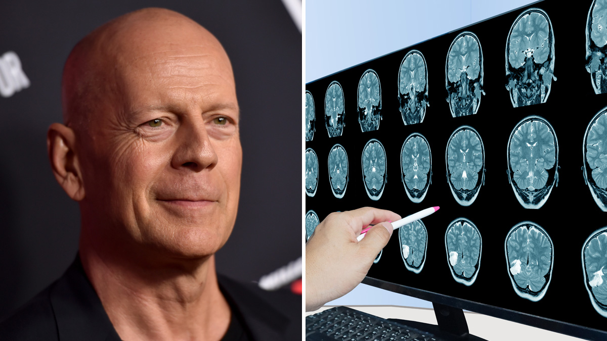 ¿Qué es la afasia? Lo que hay que saber sobre la condición que afecta a Bruce Willis