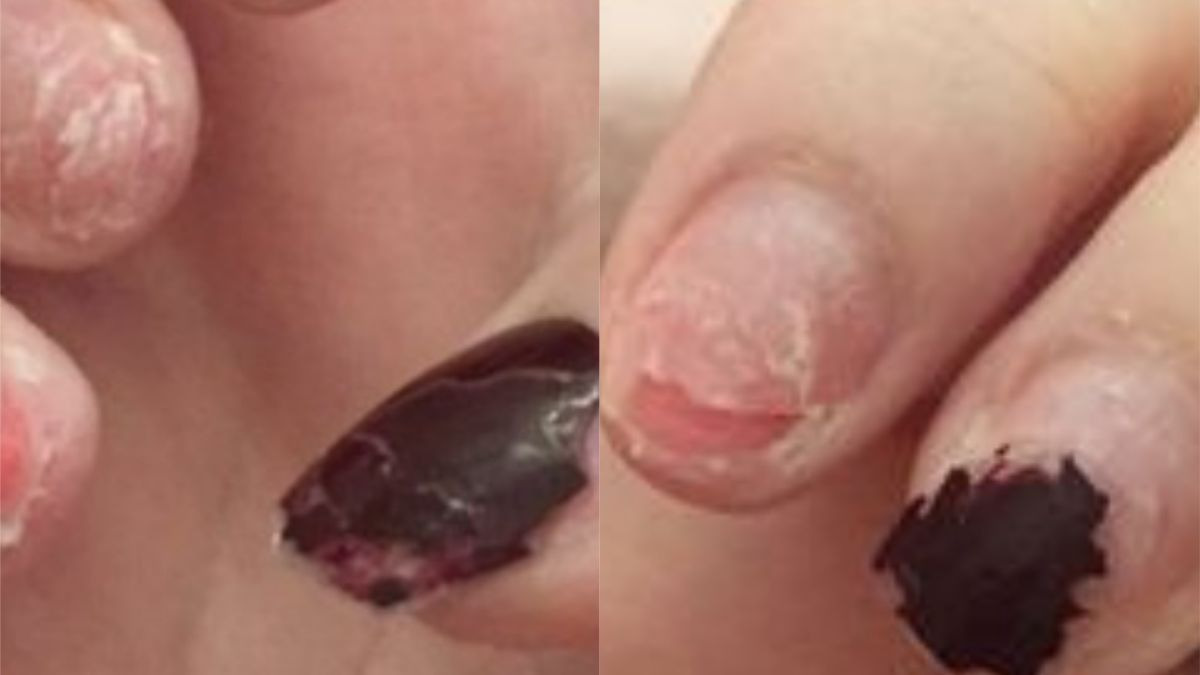 El calvario de una joven por hacerse uñas acrílicas