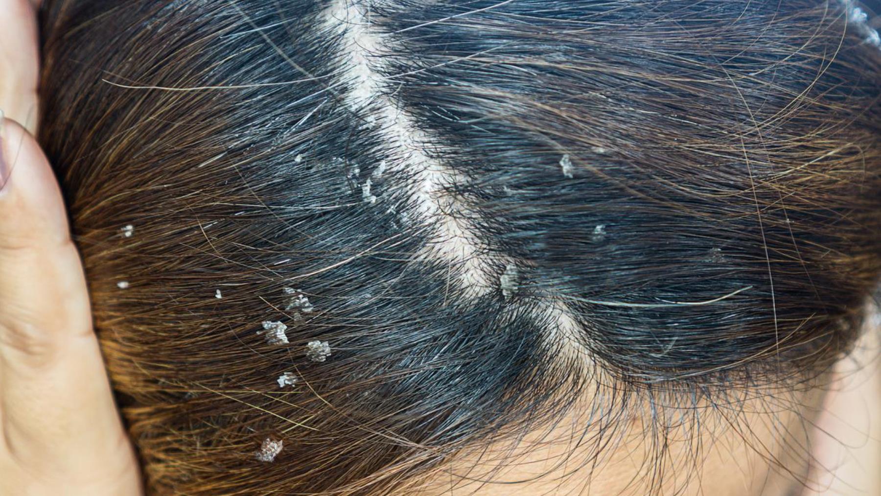 ¿Por qué sale la caspa? Te explicamos el motivo.