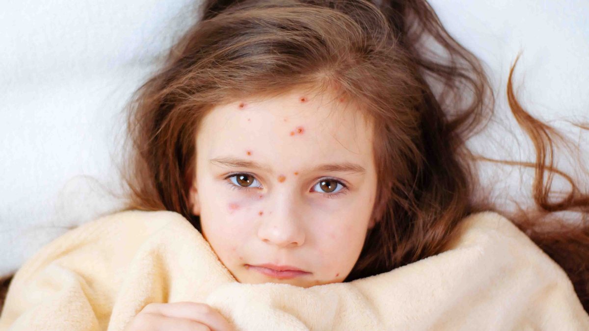 OMS: vacuna contra la viruela convencional es eficaz contra la viruela del mono