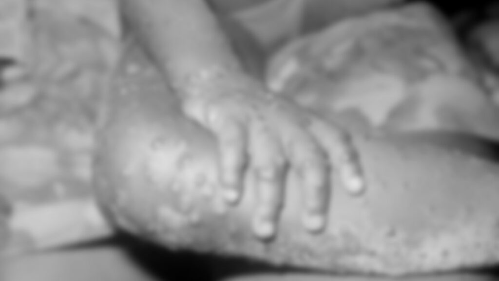 Hombre en Massachusetts diagnosticado con el raro virus ‘viruela del mono‘, dicen funcionarios de salud