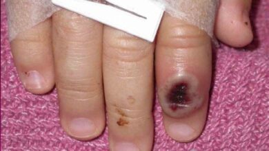 Viruela del mono: quiénes están en riesgo de contagio