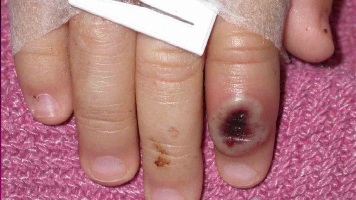 Viruela del mono: quiénes están en riesgo de contagio