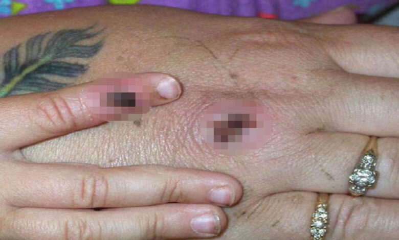 Los CDC explican cuál es la situación en EEUU con la viruela del mono