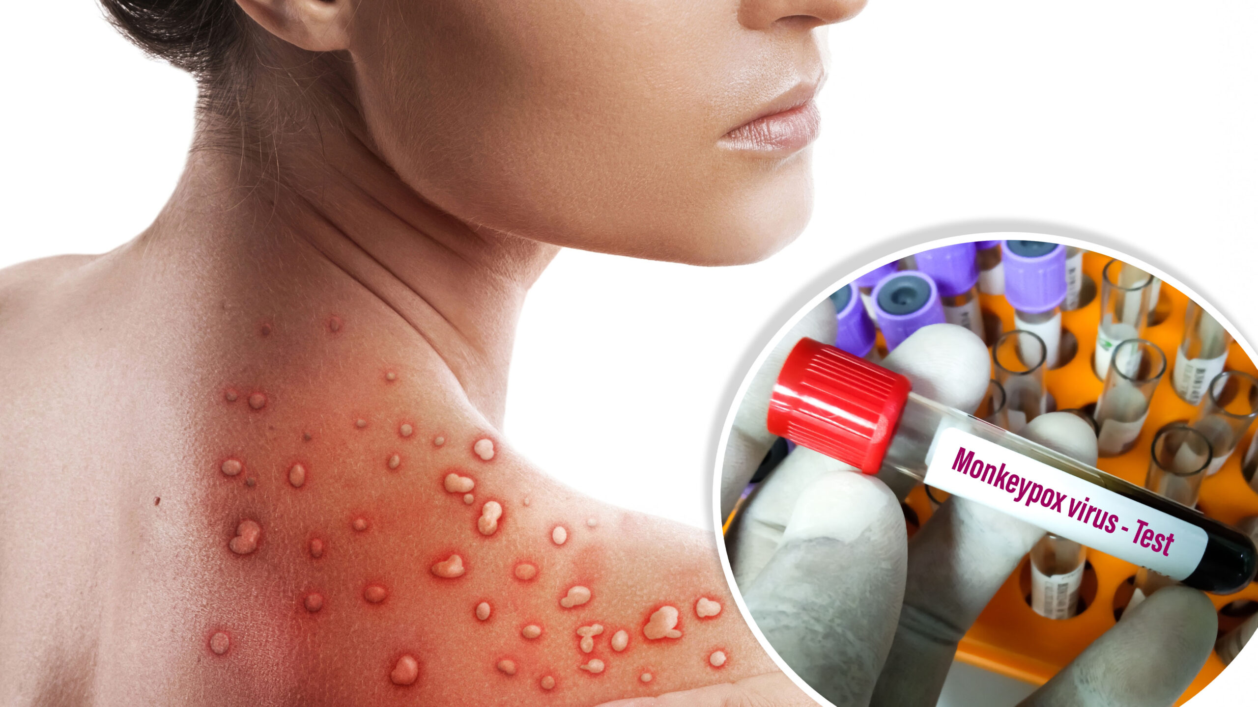 CNBC: la viruela del mono se estaría propagando principalmente a través del sexo