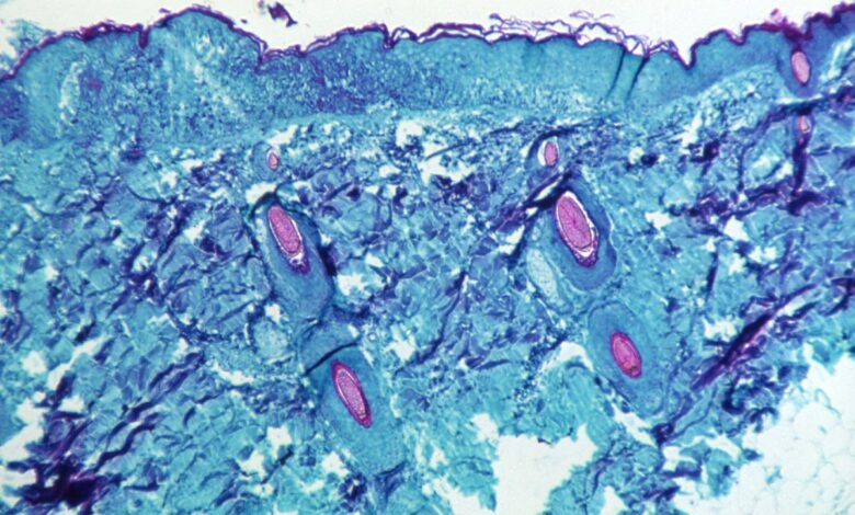 Canadá confirma dos casos de viruela del mono