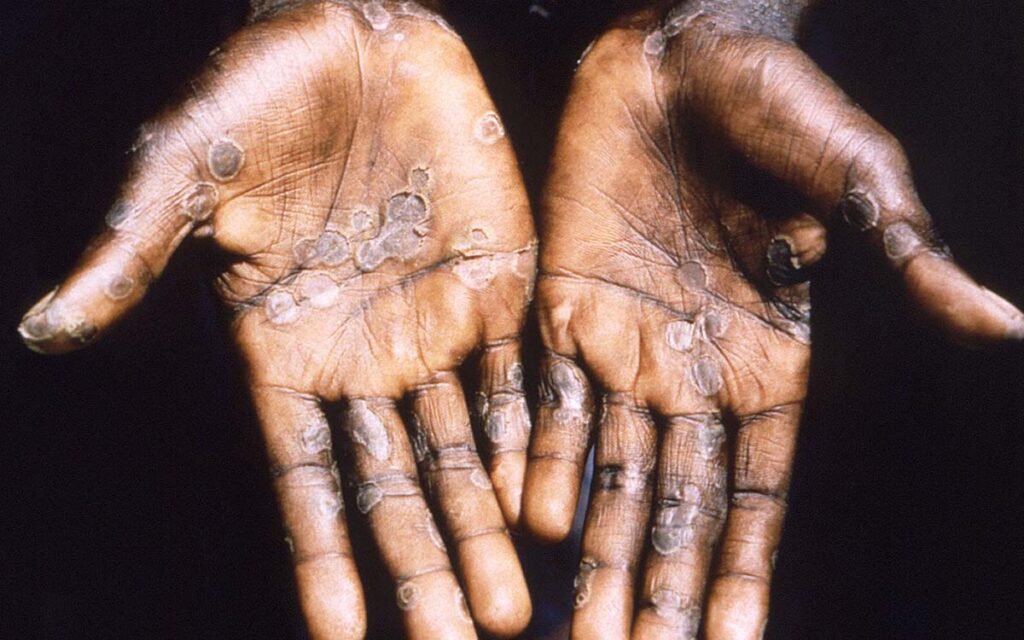 Detectan nuevos casos de viruela del mono en Alemania, Bélgica y Australia