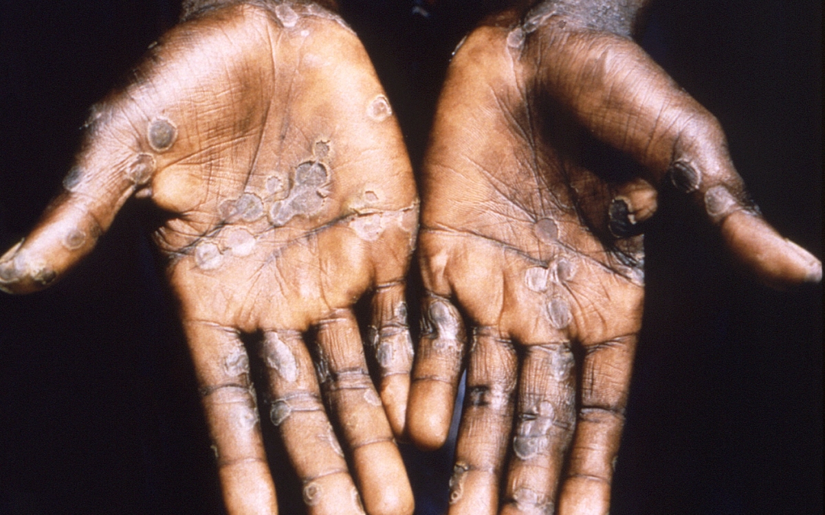 Bélgica es el primer país que declara cuarentena obligatoria por viruela del mono