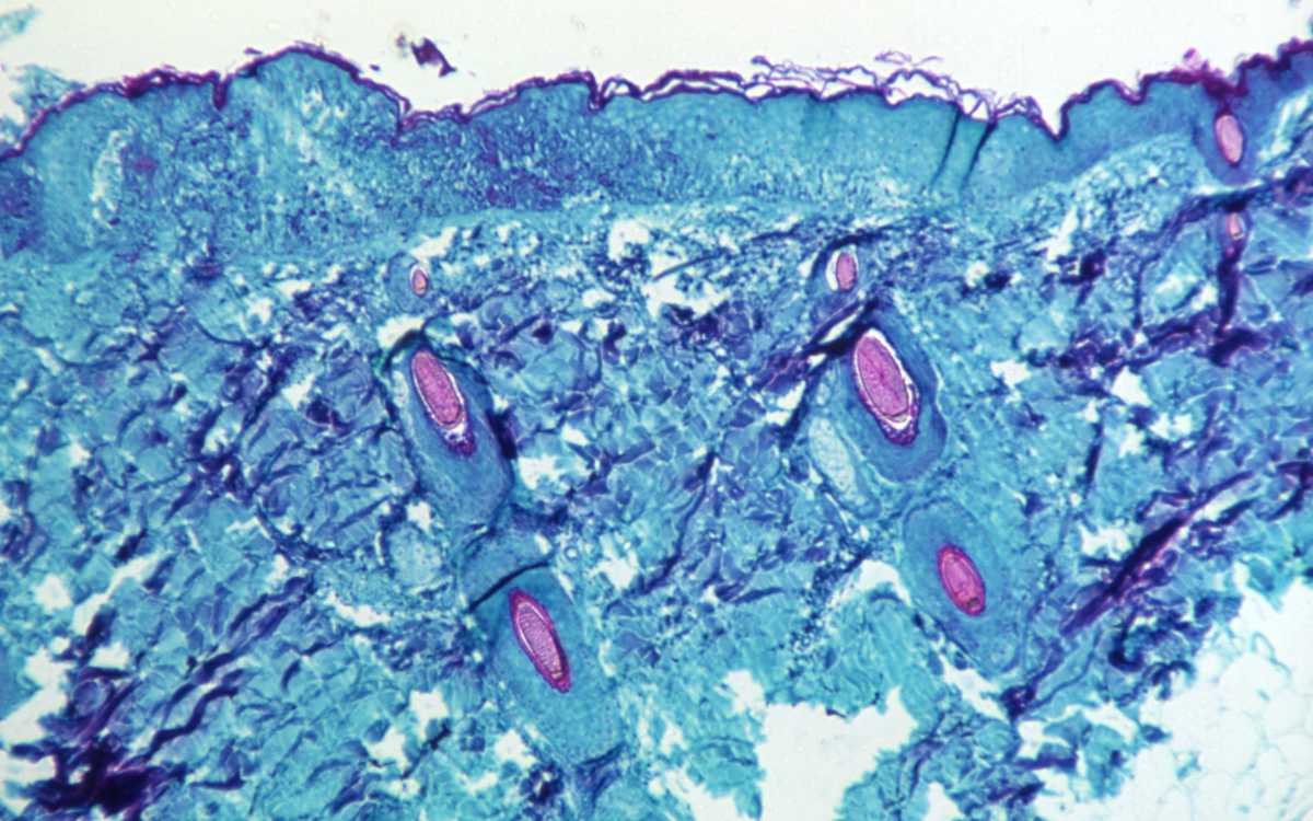 Viruela del mono representa ‘riesgo moderado’ para la salud pública mundial: OMS