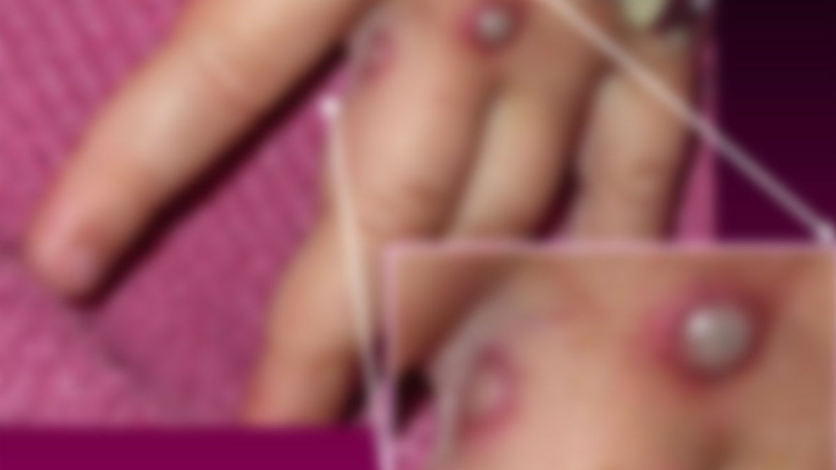 Viruela del mono: ¿Qué es y por qué esta enfermedad preocupa al Reino Unido?