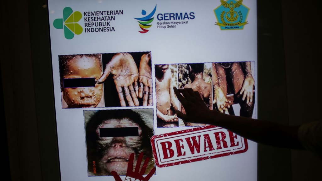 ¿Es la viruela del mono como el COVID-19? Podría deberse a contactos en dos fiestas masivas en Europa